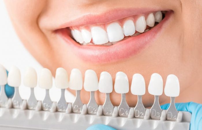 Things You Must Know Before Going For Teeth Whitening Treatment